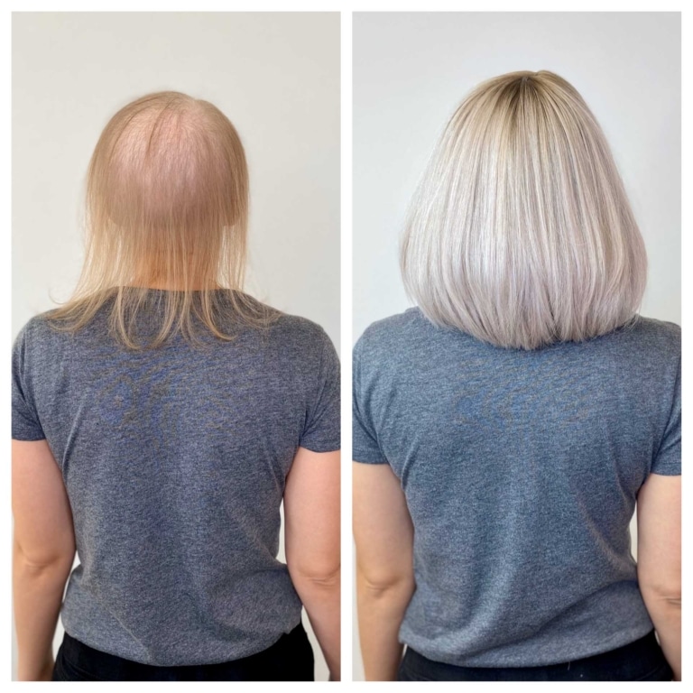 Before and after picture of woman with little hair