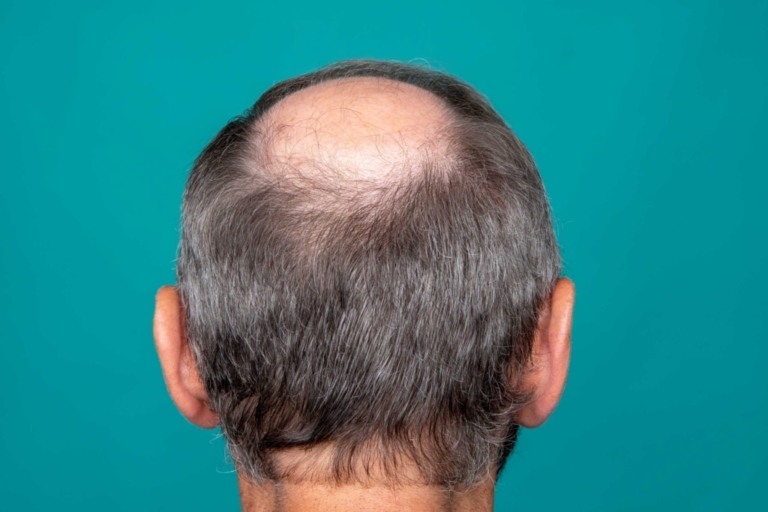 Circular areas of baldness